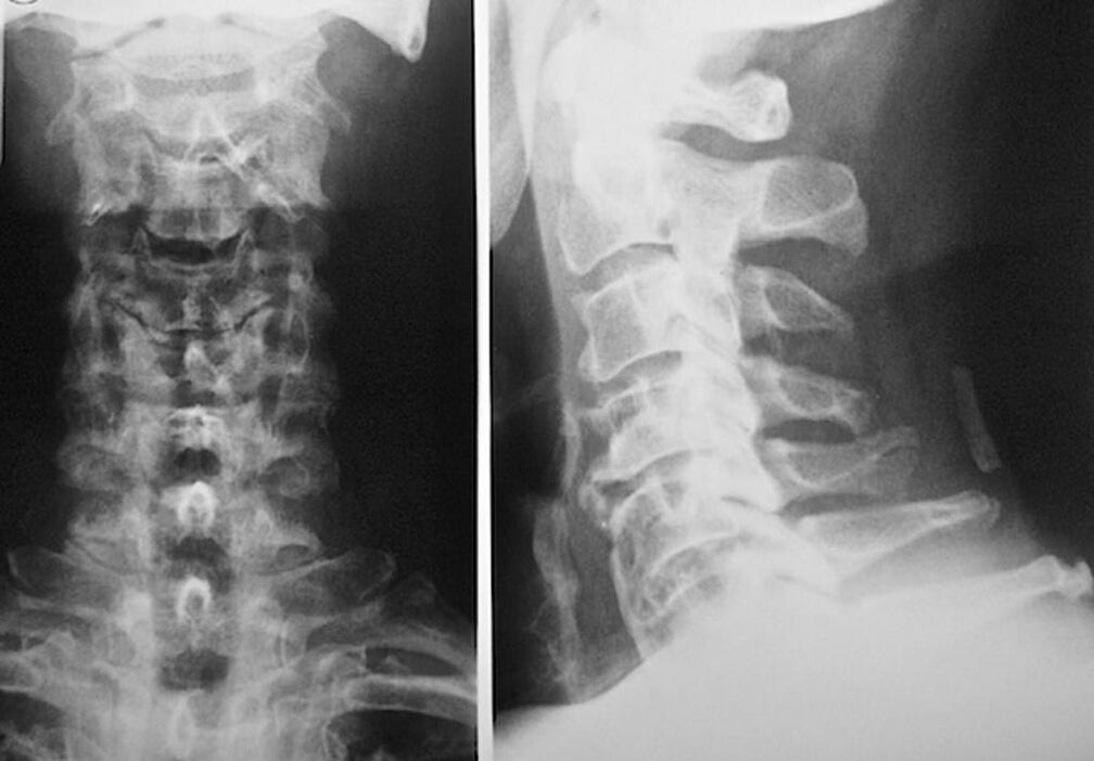 a nyaki gerinc röntgenfelvétele osteochondrosissal