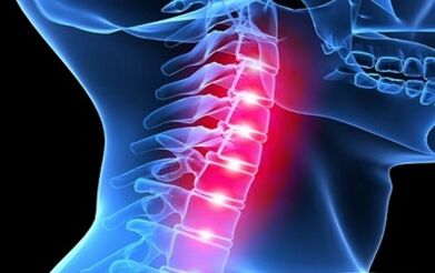 A nyaki gerinc osteokondrózisának tünetei