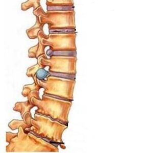 Hogyan alakul ki a méhnyak régió osteochondrosis
