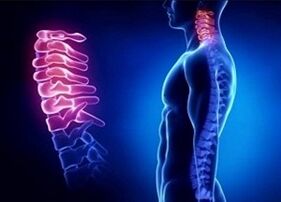 A méhnyak osteochondrosis kialakulásának okai
