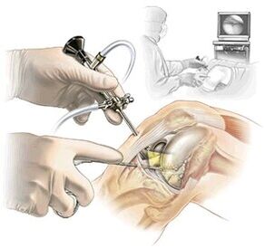 A kötőjel -gyógyszer arthrosis diagnosztizálásának tisztázása