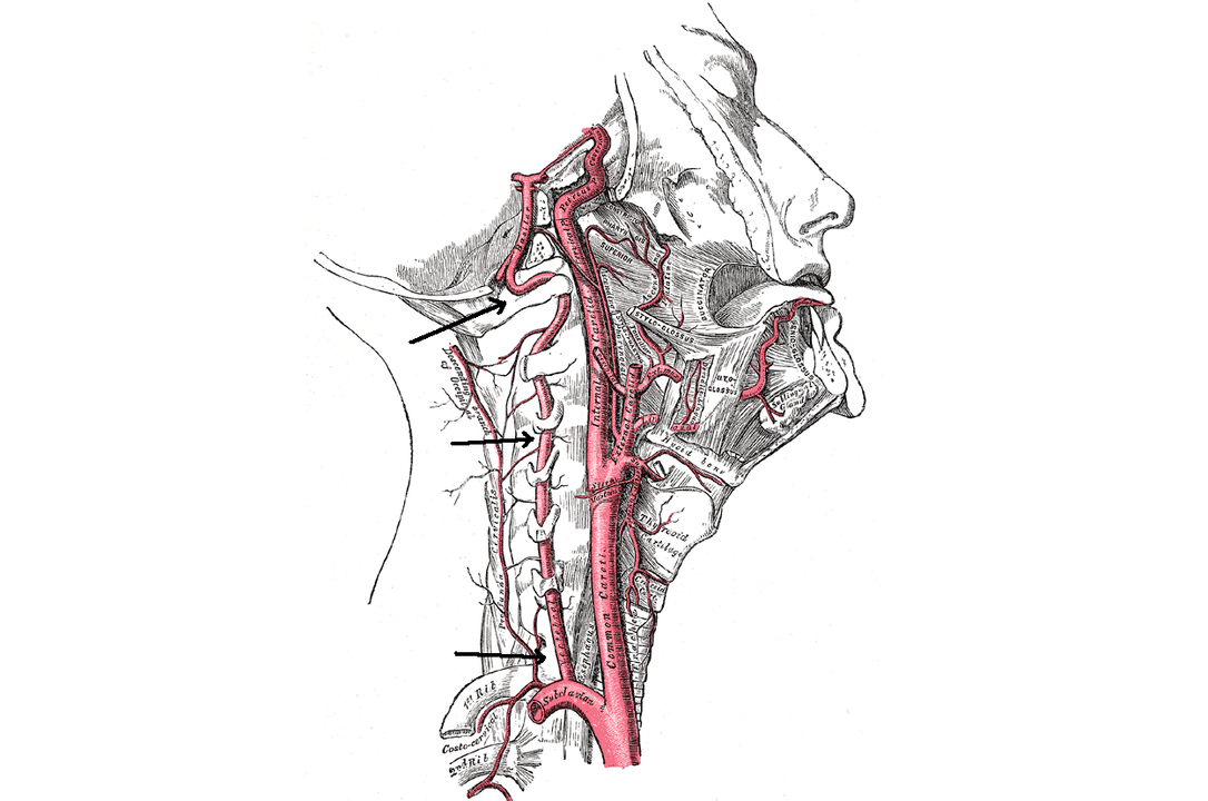 a csigolya artéria összenyomása nyaki osteochondrosissal