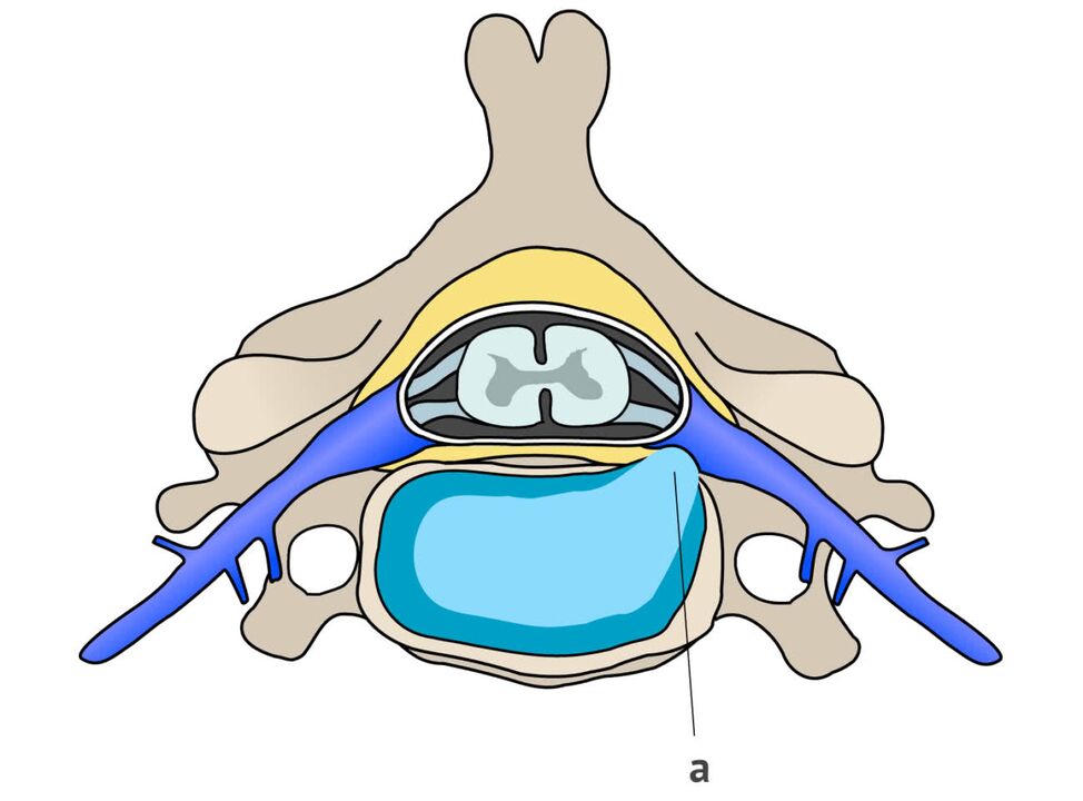 csigolyaközi sérv nyaki osteochondrosissal