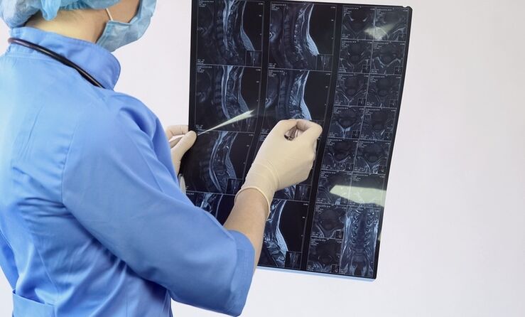A „nyaki osteochondrosis diagnózisa MRI-vizsgálat alapján történik