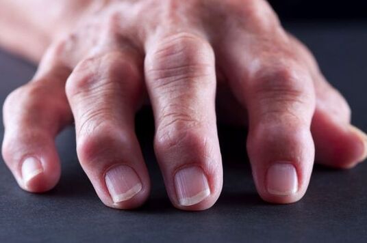 Az ujjak ízületi deformációi arthrosis vagy ízületi gyulladás következtében